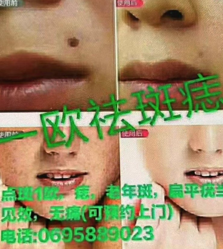 【小巴黎】专业去除斑点